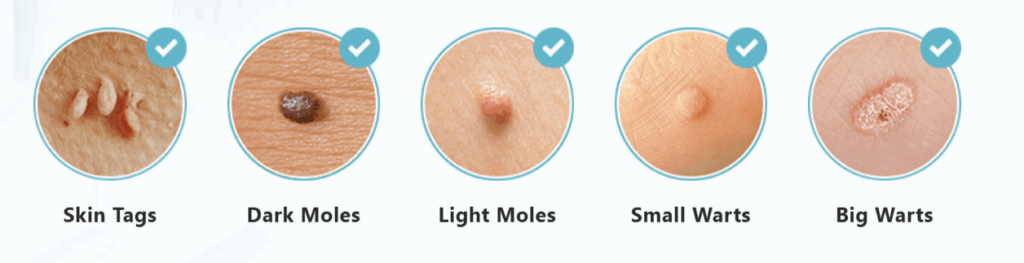 Benefits of Youthful Dermlogix Skin Tag Remover