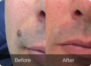 Youthful Dermlogix Skin Tag Remover Customer Reviews